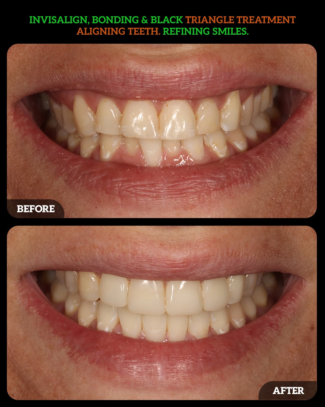 Instagram post by Dr. Aparna Sadineni, DDS: Invisalign, bonding & black triangle treatment: Aligning teeth and refining smiles! ✨😁 By combining clear aligners for predictable movement…