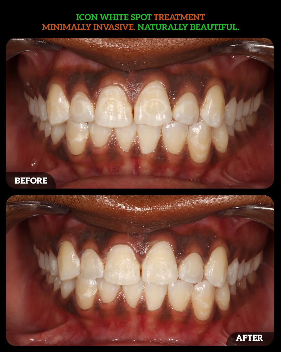 Instagram post by Dr. Aparna Sadineni, DDS: Say goodbye to stubborn white spot lesions on your teeth without drilling! ✨🦷 Icon White Spot Treatment is a micro-invasive, highly effecti…