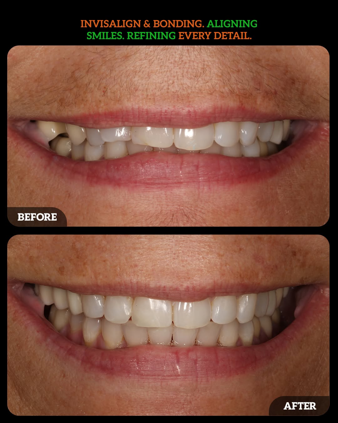 Instagram post by Dr. Aparna Sadineni, DDS: Precision alignment meet subtle artistry. 💡🦷 When orthodontics and cosmetic treatment work together, the results speak for themselves. Usi…