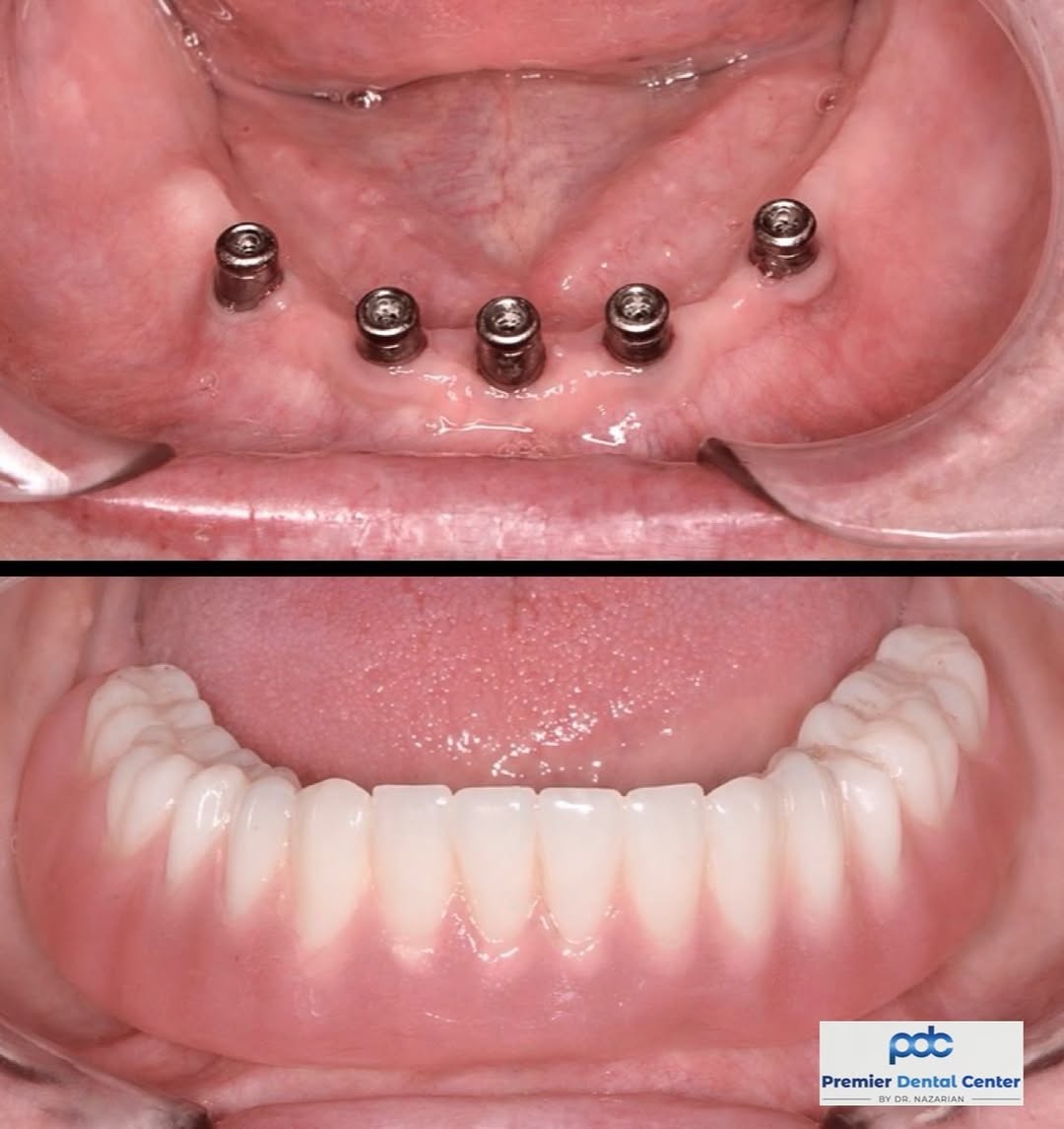 Instagram post by Dr. Ara Nazarian, DDS, DICOI: A more secure smile. An option within reach. If fixed implant teeth are beyond your budget, snap-in dentures may offer a more affordable way…