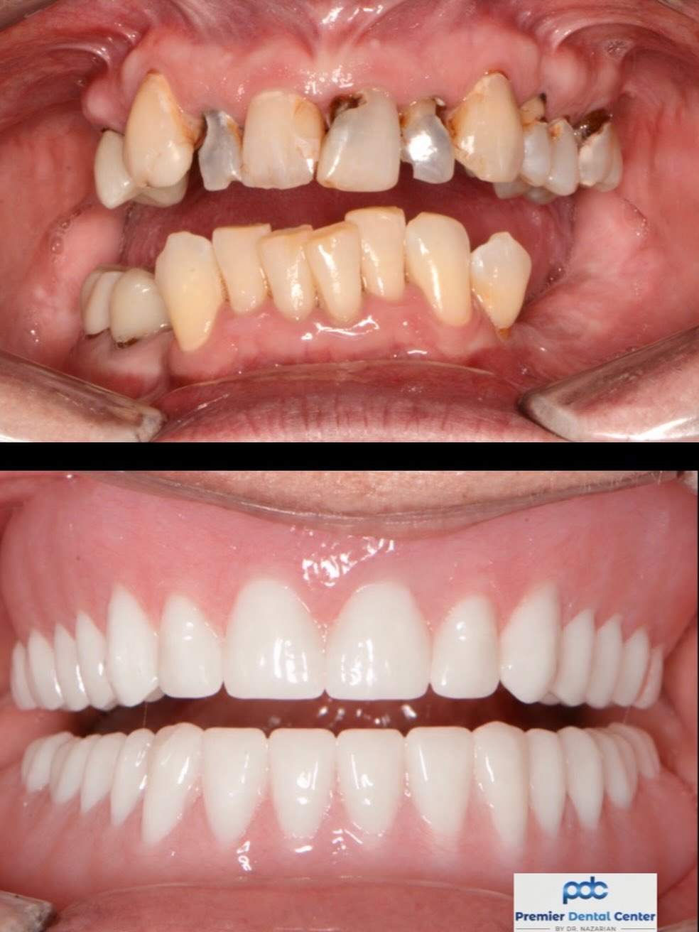 Instagram post by Dr. Ara Nazarian, DDS, DICOI: Snap-In Teeth on Dental Implants: A Stable, Affordable Alternative Not everyone is ready for—or needs—a fully fixed implant solution. Implan…