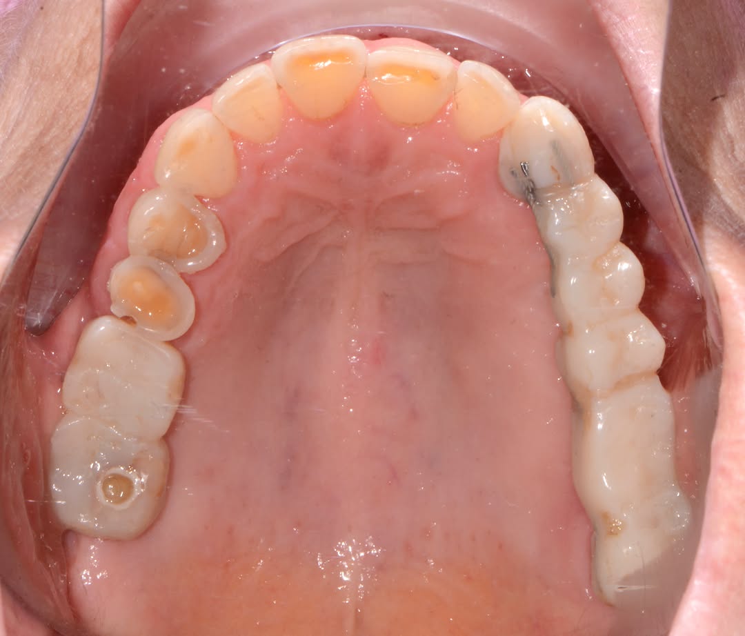 Instagram post by Dr. Ara Nazarian, DDS, DICOI: Restoring What Was Missing. Rebuilding What Was Worn. This patient presented with missing posterior teeth and significant wear of the remain…