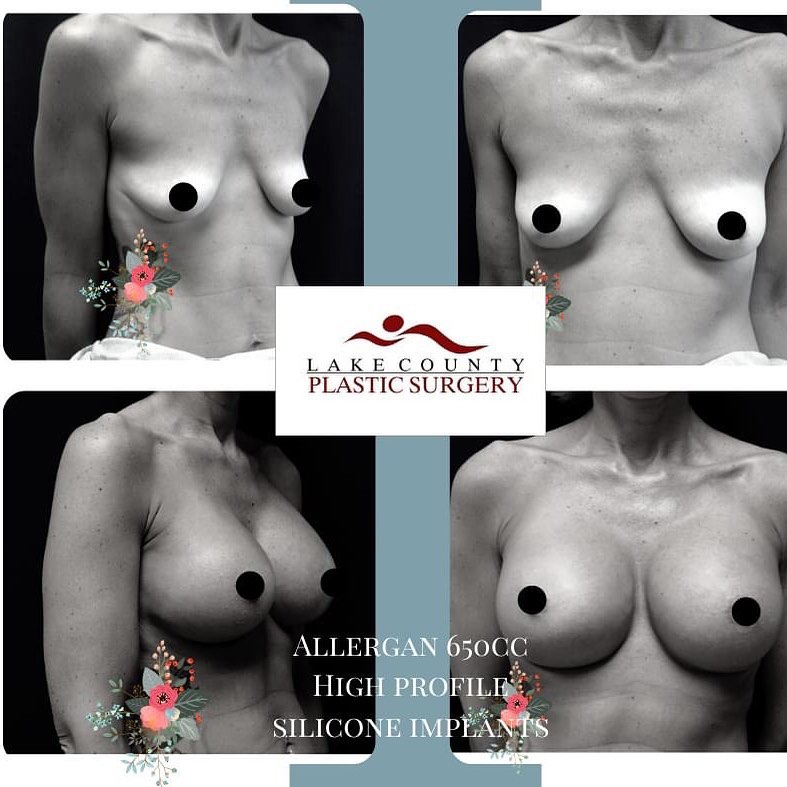 Instagram post by Dr. Aras Tijunelis: #plasticsurgery #breastimplants @allerganaesthetics #cosmeticsurgery #siliconeimplants #glowup #surgeon #plasticsurgeon #libertyville #liber…
