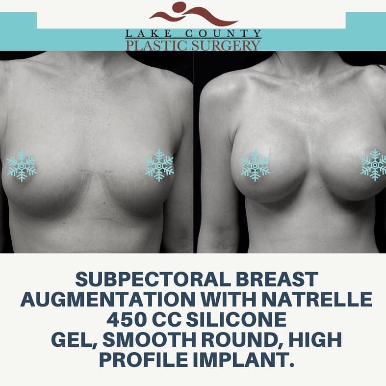 Instagram post by Dr. Aras Tijunelis: #breastaugmentation #breastimplants #implants #plasticsurgery @allerganaesthetics #allerganimplants @natrellebreastaugmentation #glowup #bef…