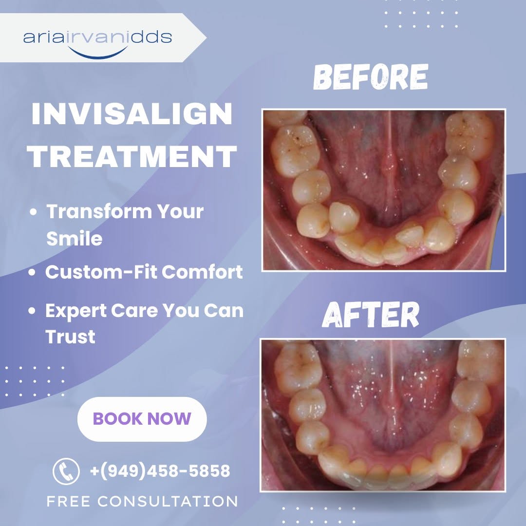 Instagram post by Dr. Aria Irvani, DDS: See the incredible before-and-after results of Invisalign® treatment by Dr. Aria Irvani! 🙌 Whether you're looking to enhance your smile or …