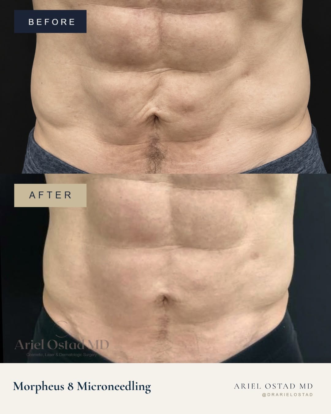 Instagram post by Dr. Ariel Ostad: A great example of how treating the skin can transform the contour. This before & after demonstrates the improvement in abdominal skin laxit…