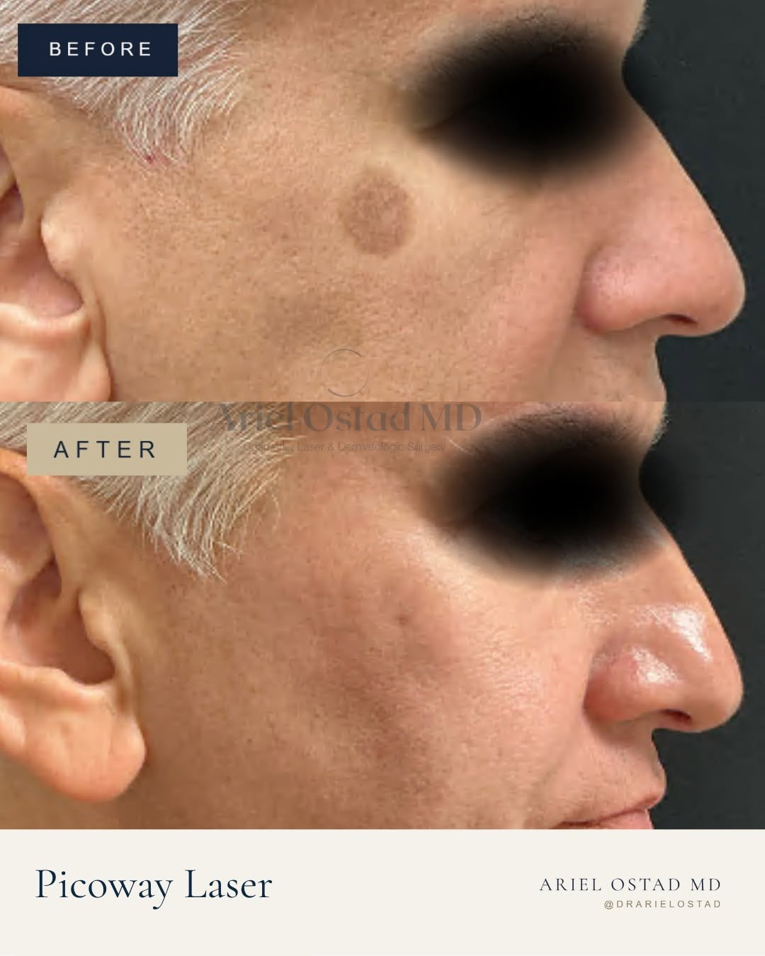 Instagram post by Dr. Ariel Ostad: Clearer skin begins with precision. Brown spots and unwanted pigmentation can create unevenness in the complexion, even when the surrounding…