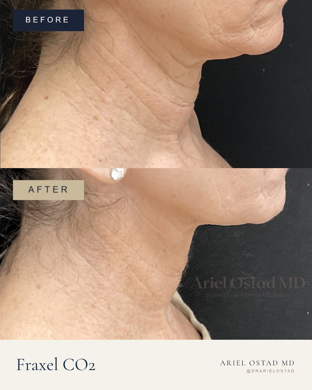 Instagram post by Dr. Ariel Ostad: The neck is often one of the first areas to show visible signs of aging, yet it can be one of the most challenging areas to rejuvenate. This…