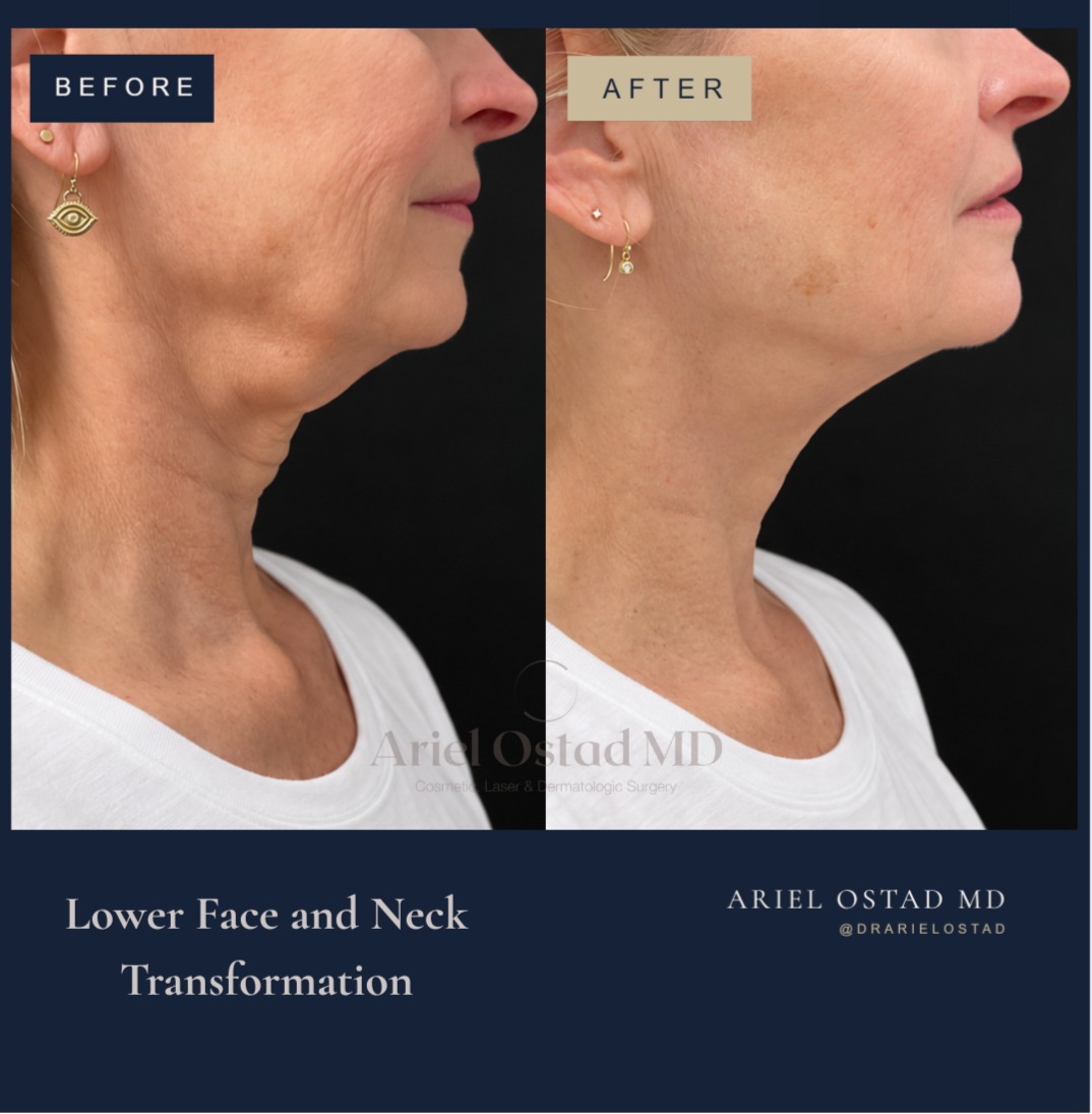 Instagram post by Dr. Ariel Ostad: Improving the lower face and neck doesn’t always require surgery. This result was achieved through a customized combination of non-surgical …