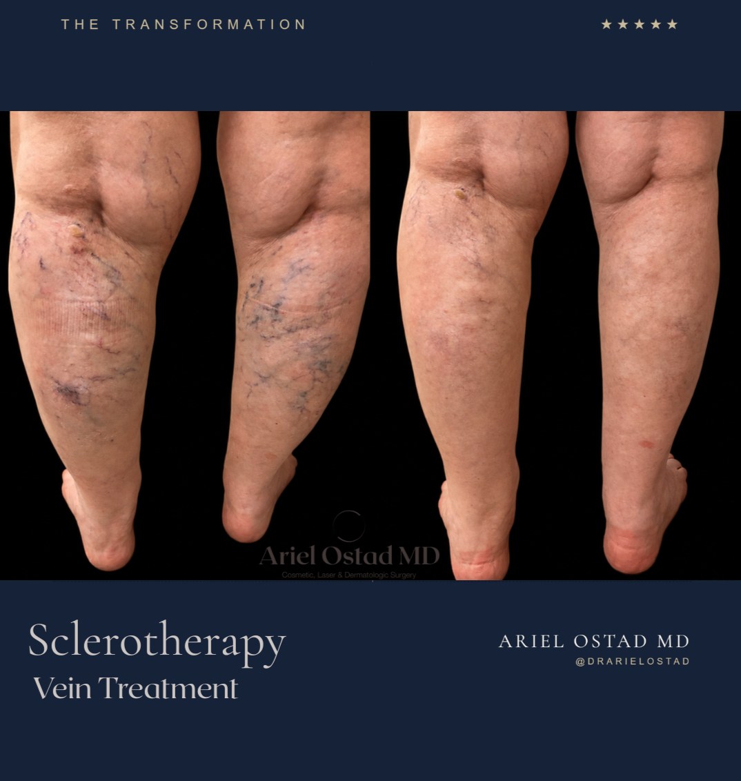 Instagram post by Dr. Ariel Ostad: A beautifully noticeable difference. Sclerotherapy is a precise, minimally invasive treatment designed to target unwanted spider veins by us…