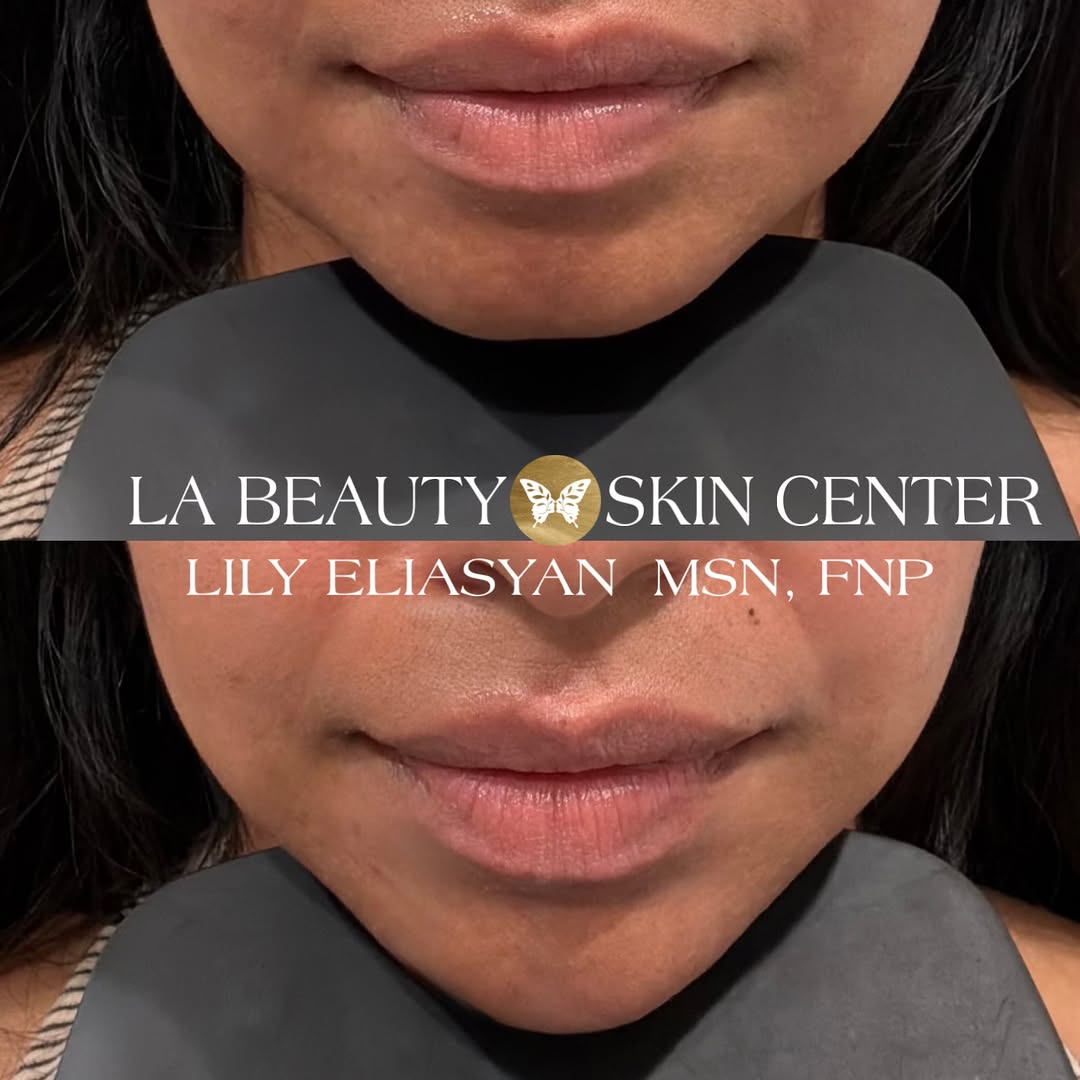 Instagram post by Dr. Arman F. Karapetyan: From W to V 🔥 Chin enhancement by @npinjectorlily 🤍 📍501 S Central Ave, Glendale, CA, 91204 📱818.888.0001 #chin #la #beforeandafter #inj…