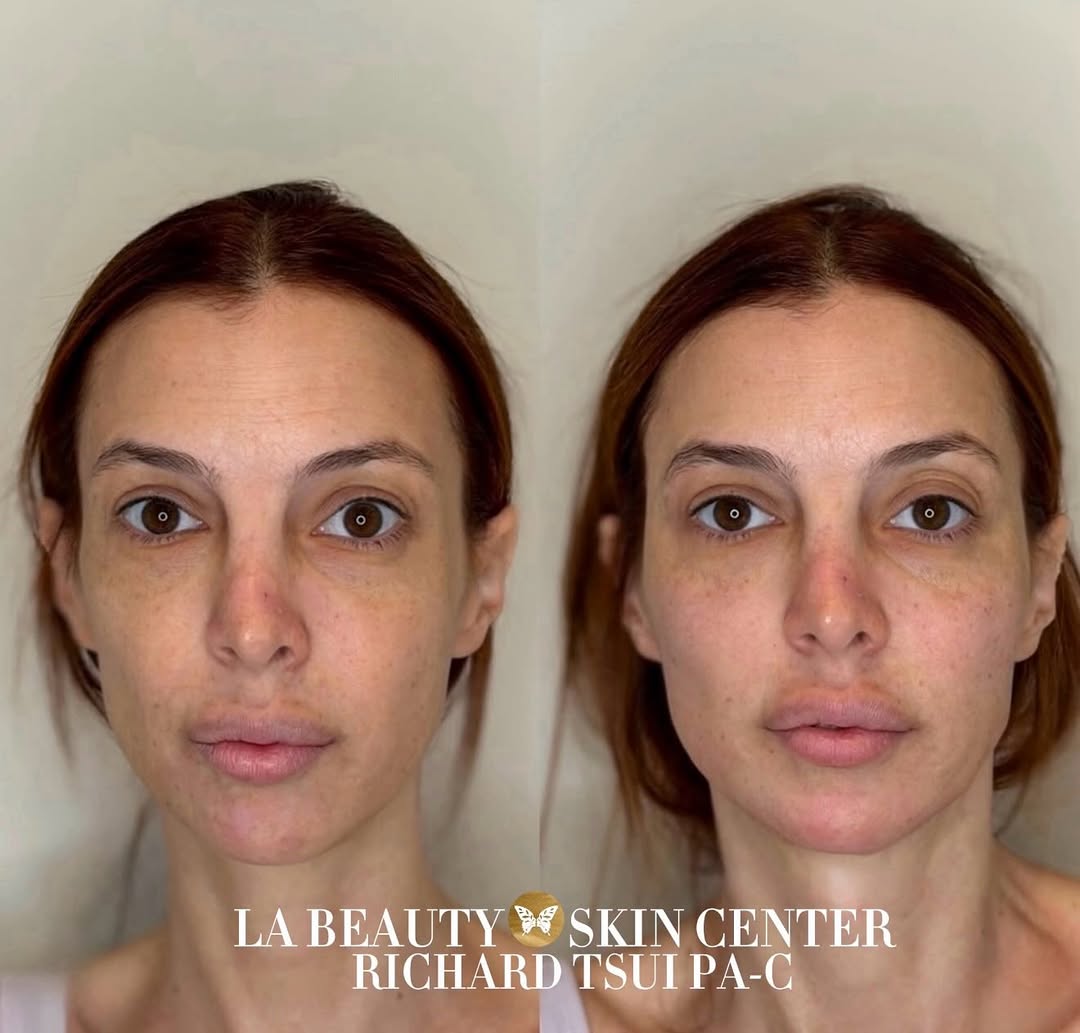 Instagram post by Dr. Arman F. Karapetyan: •Facial Balancing ✨• Performed by Richard 💉 📍 North Hollywood INJECTABLES SPECIALS 💉 Per 1ml syringe of Juvederm Family Fillers $75 OFF P…