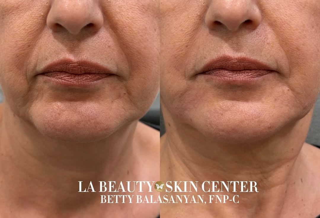 Instagram post by Dr. Arman F. Karapetyan: •Chin Shadows Can Be A Subtle Touch That Makes A Huge Difference ✨• Performed by Betty! 📍 North Hollywood & Pasadena Call Us To Schedule An…