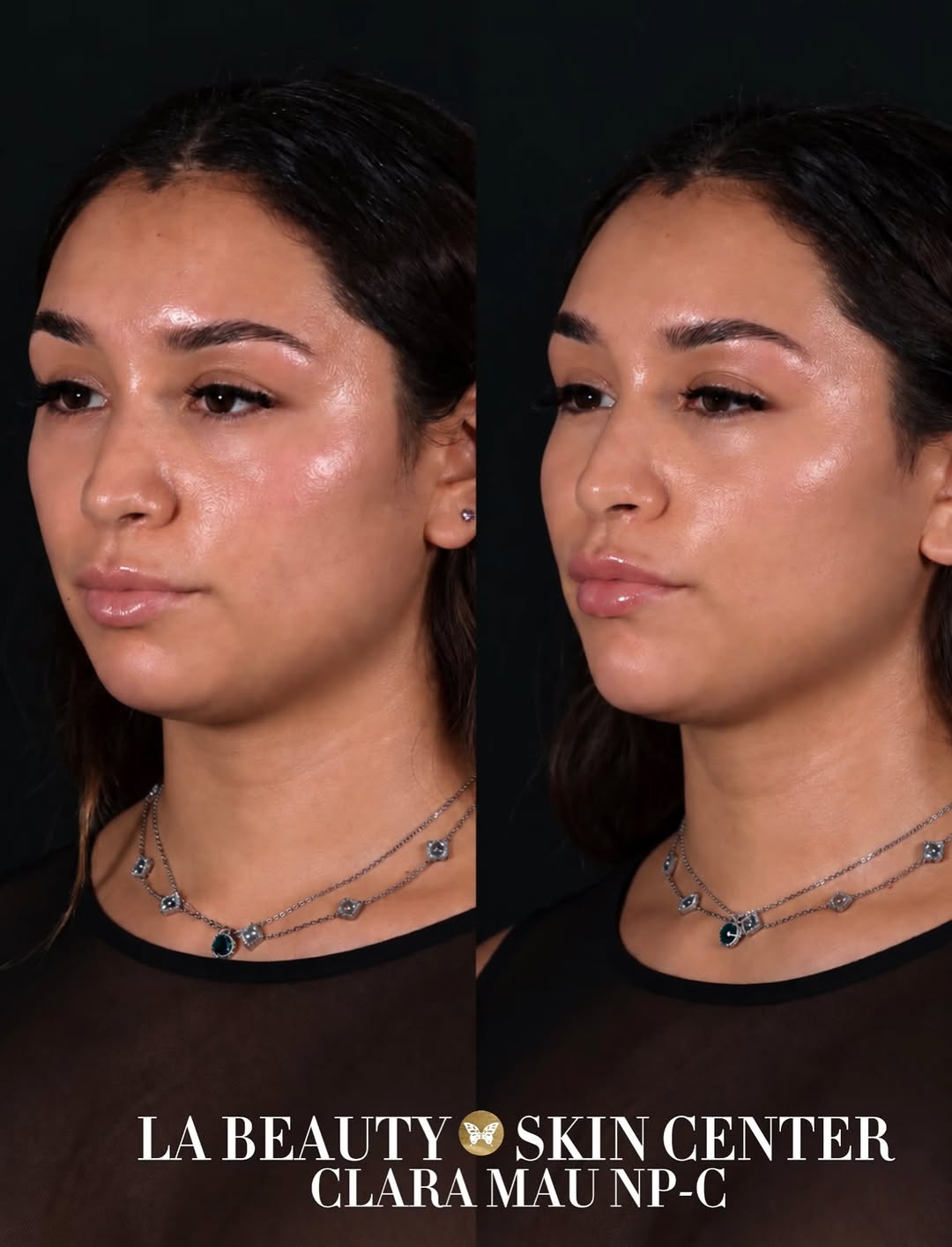 Instagram post by Dr. Arman F. Karapetyan: •Before & Immediately After Full Facial Balancing 💉• Performed by Clara! 🤍 📍 North Hollywood Call Us To Schedule An Appointment! 📞 818.8…