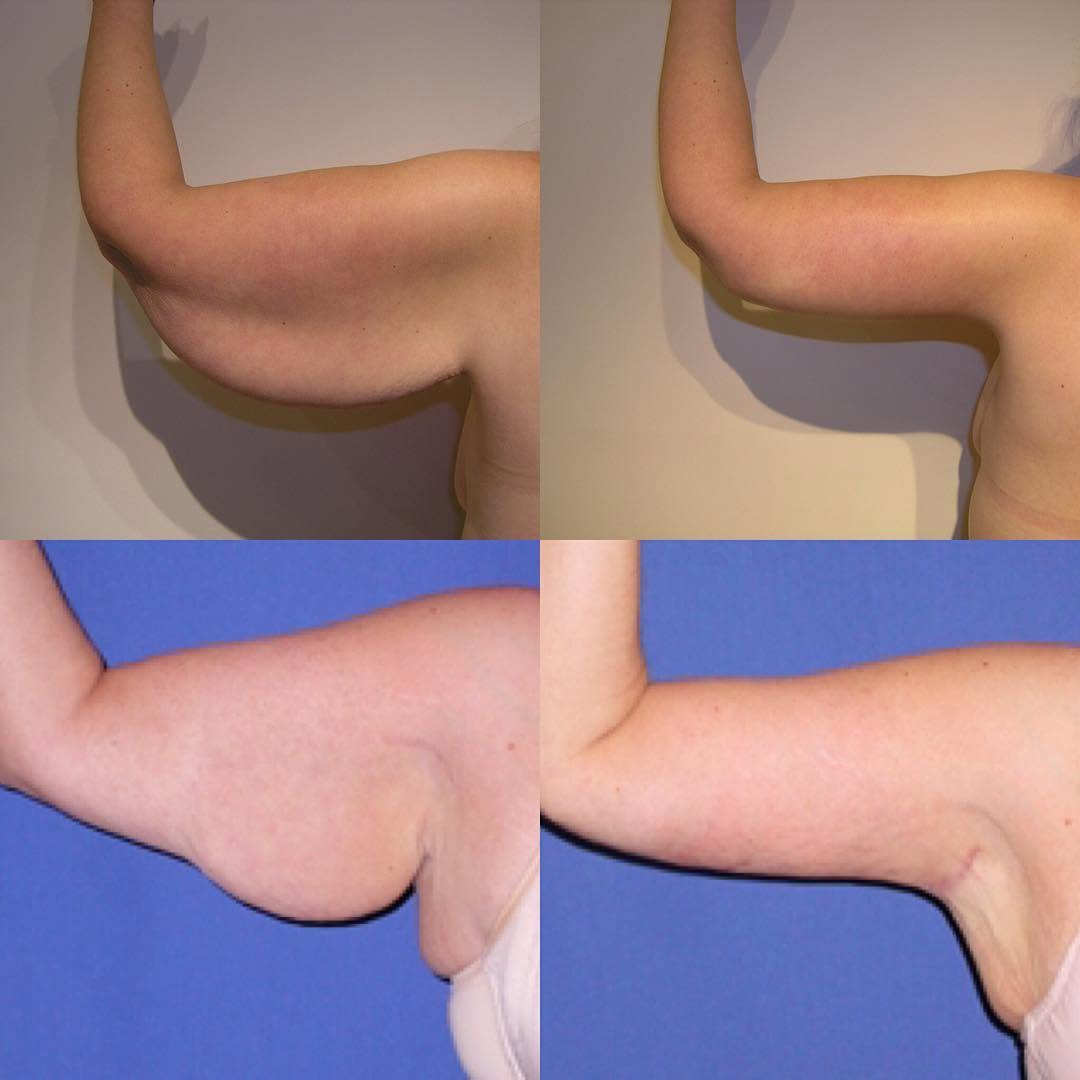 Instagram post by Dr. Armand V. Simone: Arm reduction- more comfort, more confidence, more clothing choices!! Armand Simone MD NYC plastic surgeon #armreduction #clothes #brachiopl…