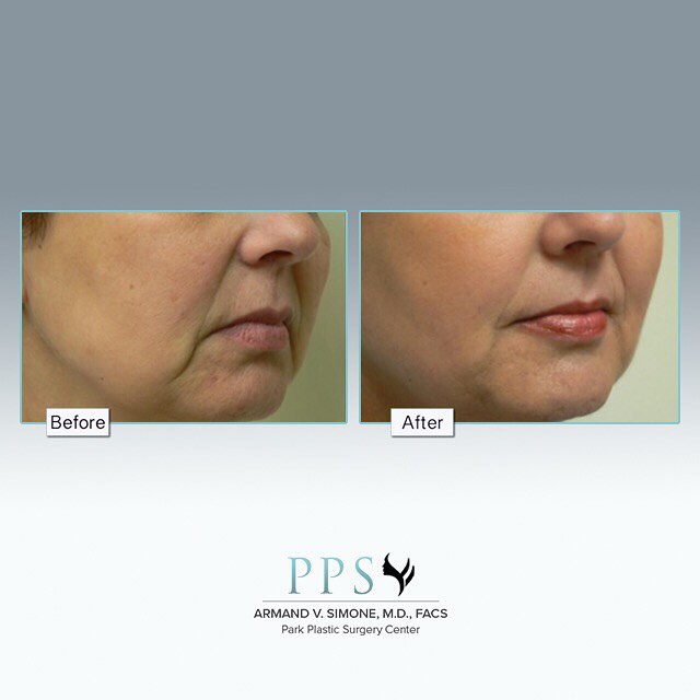 Instagram post by Dr. Armand V. Simone: Looking to #plump up those lips? This non-surgical treatment will take aging out of your face with #Safe, hypoallergenic, natural HA fillers…