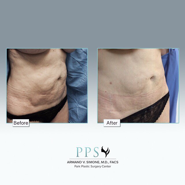 Instagram post by Dr. Armand V. Simone: Patients who have protruding abdomens as a result of weak abdominal muscles, weight gain, sagging skin and an excess fat layer are the usual…