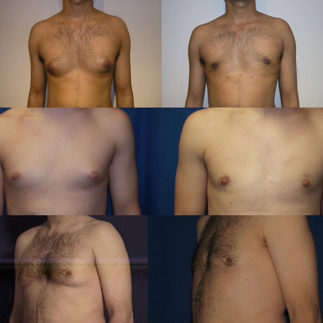 Instagram post by Dr. Armand V. Simone: Gynecomastia = excess male breast size. Be confident with renewed body image Dr Armand Simone #gynecomastia #breast #confidence #malebody #m…