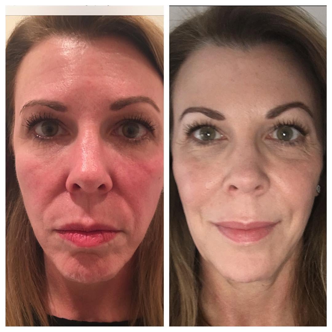 Instagram post by Dr. Armand V. Simone: Look better without surgery. For those on the go looking to enhance their appearance #facelift #botox #facialfillers #faces #sculptra #hyalu…