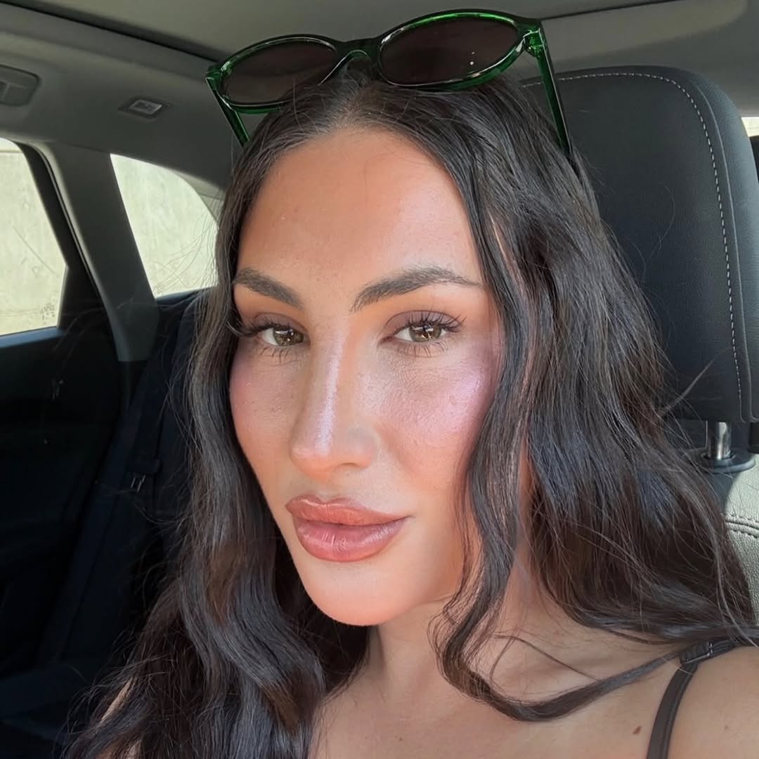 Instagram post by Dr. Armen Vartany: 2 years post-op and still looking this good ✨🤍 A beautiful example of how rhinoplasty results continue to refine and settle over time. Natu…