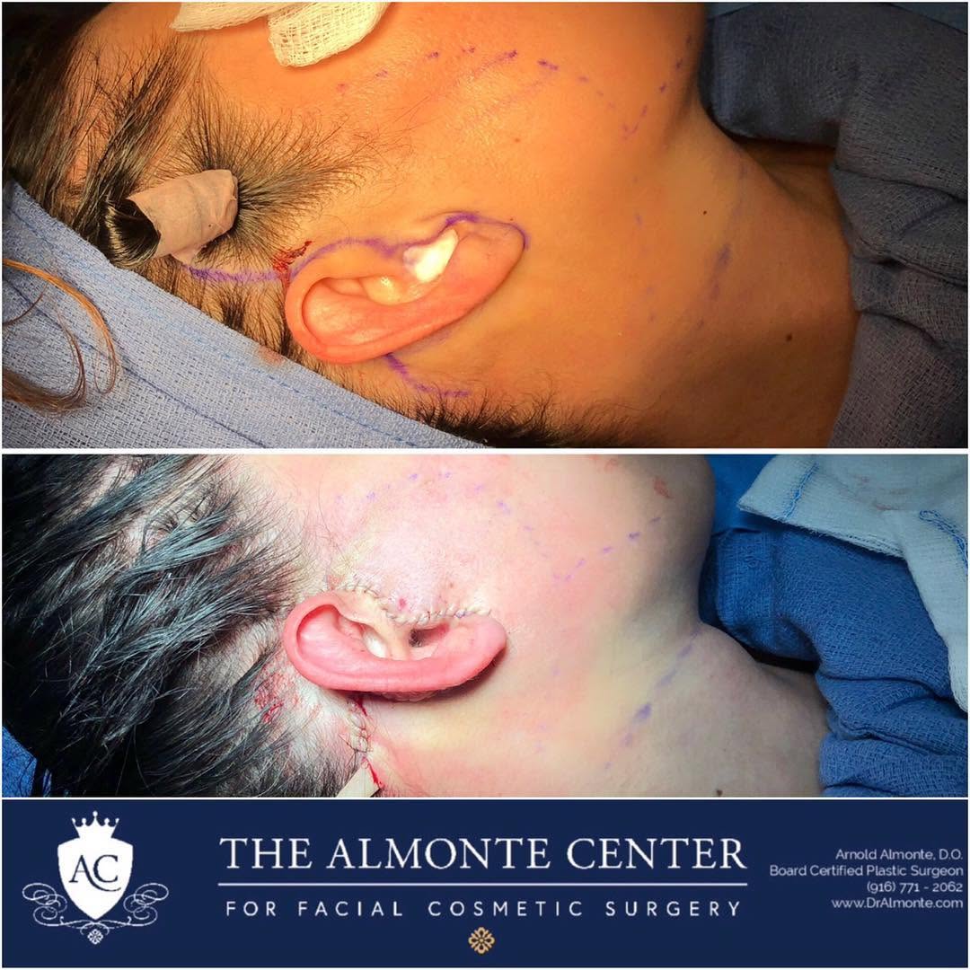 Instagram post by Dr. Arnold Almonte, DO: This is an immediate “before and after” of the INCISION site of an A-Lift! This beauty is 42 years old and had started to notice some saggin…