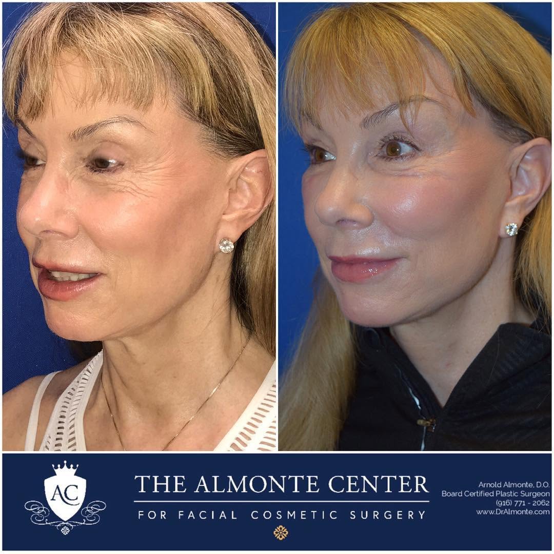 Instagram post by Dr. Arnold Almonte, DO: A Fat Transfer is one of the most popular procedures here at The Almonte Center And is appropriate for most every age! 👍😁 • We lose volume…