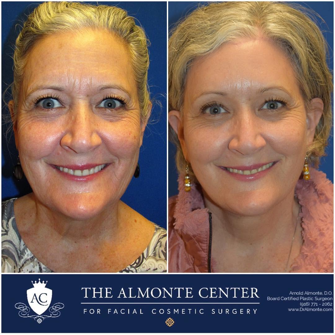 Instagram post by Dr. Arnold Almonte, DO: 🧐🎉Check out this stunning transformation!!! 😲😍 • This 59 year old female who came to The Almonte Center requesting facial rejuvenation t…