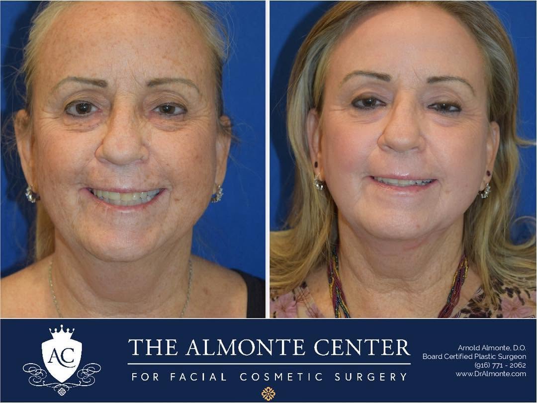 Instagram post by Dr. Arnold Almonte, DO: 😁❄️So nice to see this beauty again!!! She had Renuvion skin resurfacing performed by Dr. Almonte about 6 months ago and she is LOVING her …
