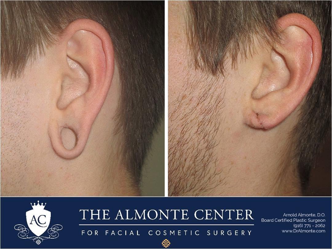 Instagram post by Dr. Arnold Almonte, DO: 🎉Getting your earlobes 👂 repaired is something that a lot of people think about🤔 but don’t realize it can be done so easily!! 😲 • This q…