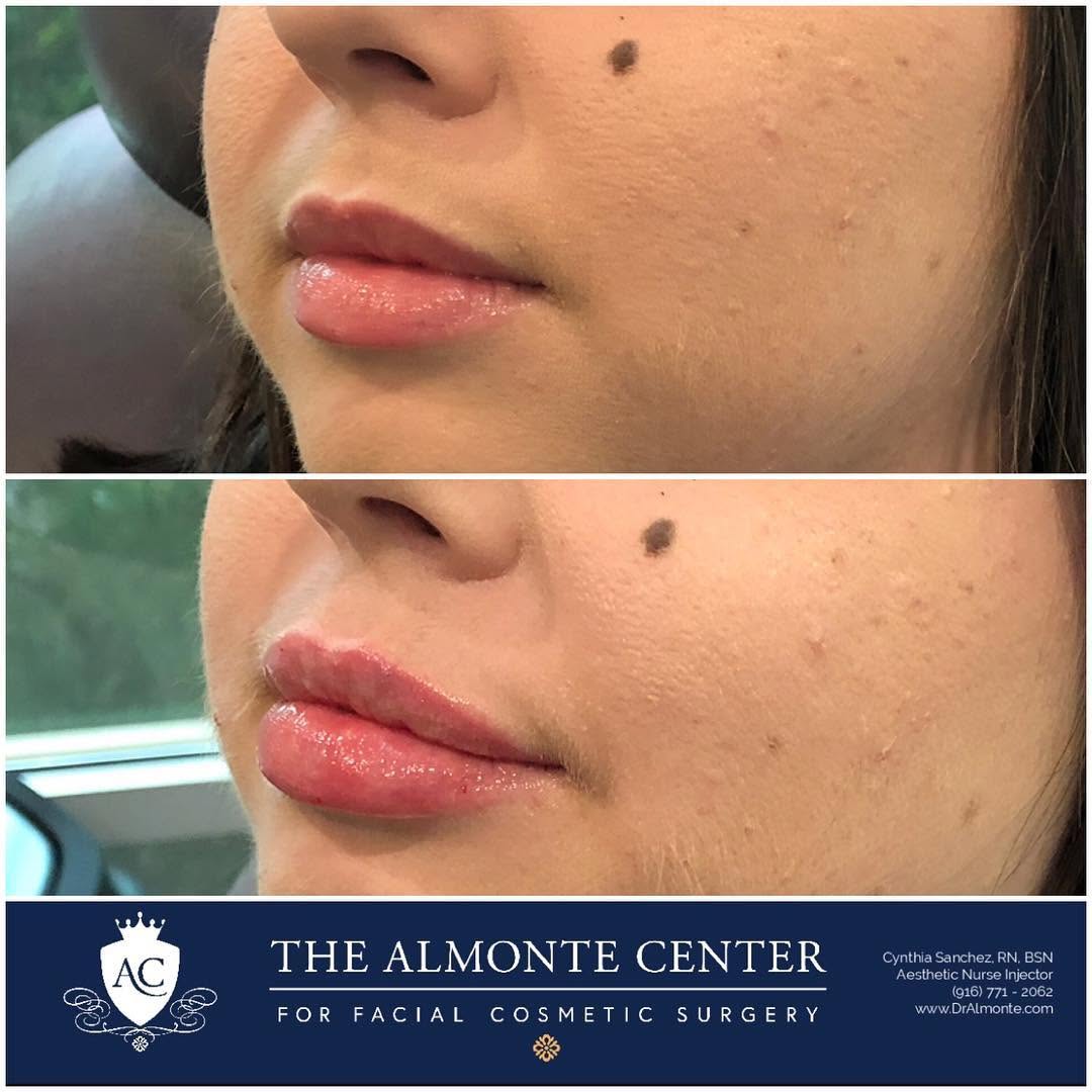 Instagram post by Dr. Arnold Almonte, DO: 👄Look at these super cute LIPS!!! 👄 • It was her first time getting fillers in her lips and were so happy she chose The Almonte Center! Ou…