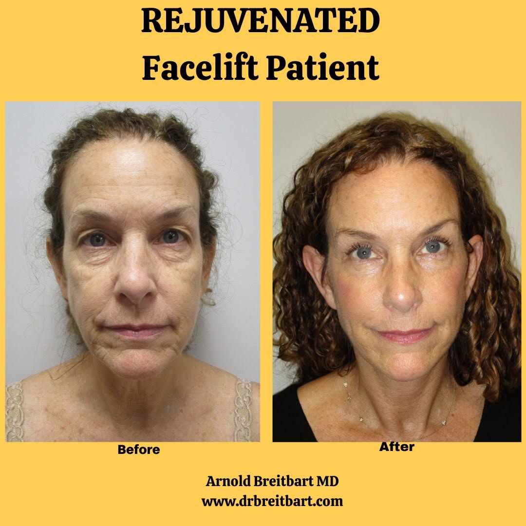 Instagram post by Dr. Arnold S. Breitbart: Turn back that clock! 2 months after facelift by Dr. Breitbart, and she’s looking over 20 years younger. #facelift #rejuvenation #plasticsur…