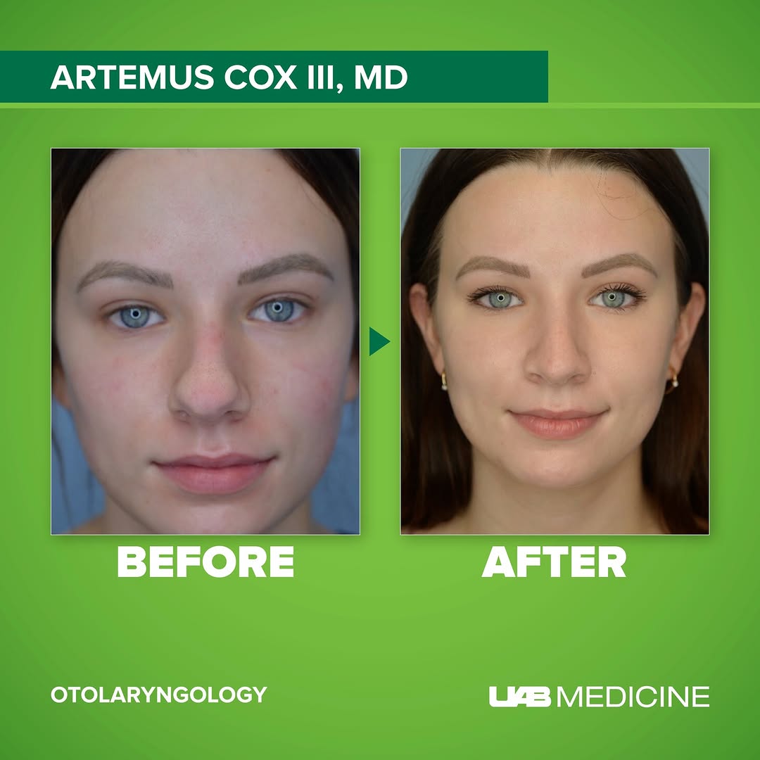 Instagram post by Dr. Artemus Cox: This patient was just overall not happy with the shape or form of her nose before surgery but, 3 months post surgery is very happy and excit…