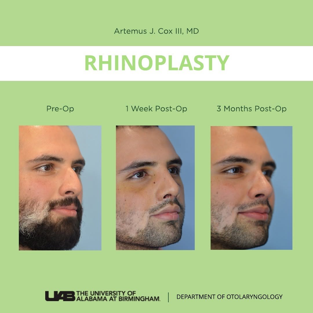 Instagram post by Dr. Artemus Cox: Pictured above are before and after progress photos of a patient who underwent cosmetic and functional rhinoplasty with a reduction of dorsa…