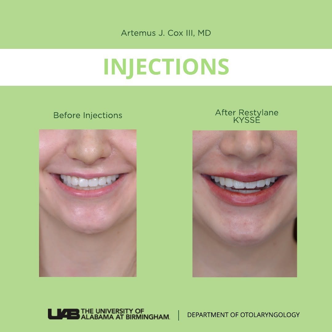 Instagram post by Dr. Artemus Cox: We offer Restylane KYSSE filler for patients who wish to add volume, enhance lip color, and smooth upper lip lines. For this patient, filler…