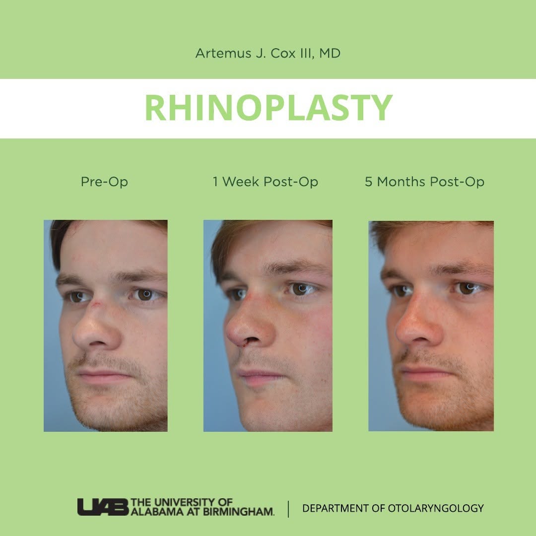 Instagram post by Dr. Artemus Cox: This patient suffered from a traumatic nasal bone fracture and deviated septum, which resulted in a significant change in his breathing and …