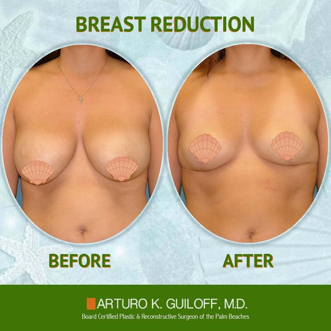 Instagram post by Dr. Arturo Guiloff: Procedures performed by the premier cosmetic & reconstructive surgeon in Palm Beach, these before & after photos are Dr. Guiloff's satisfied…
