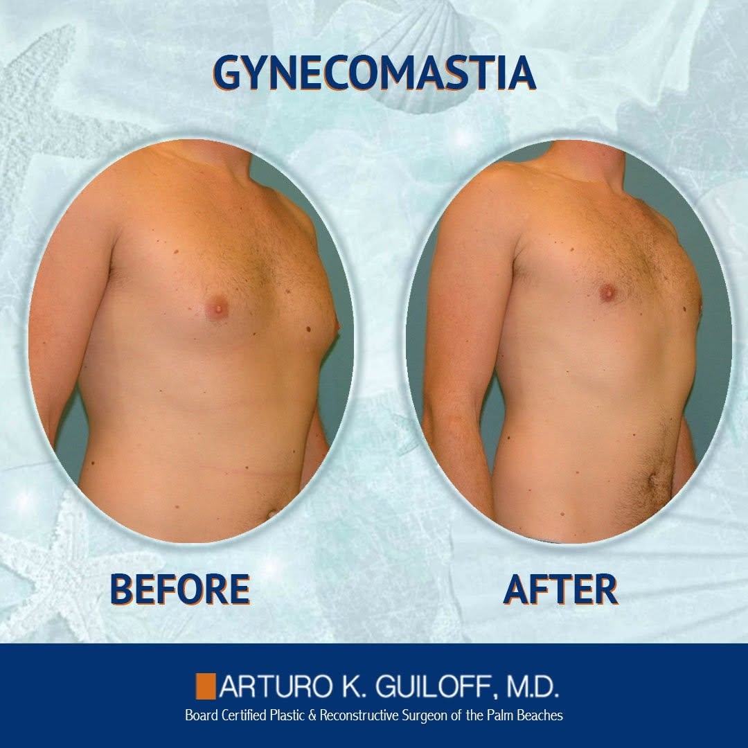 Instagram post by Dr. Arturo Guiloff: Procedures performed by the premier cosmetic & reconstructive surgeon in Palm Beach, these before & after photos are Dr. Guiloff's satisfied…