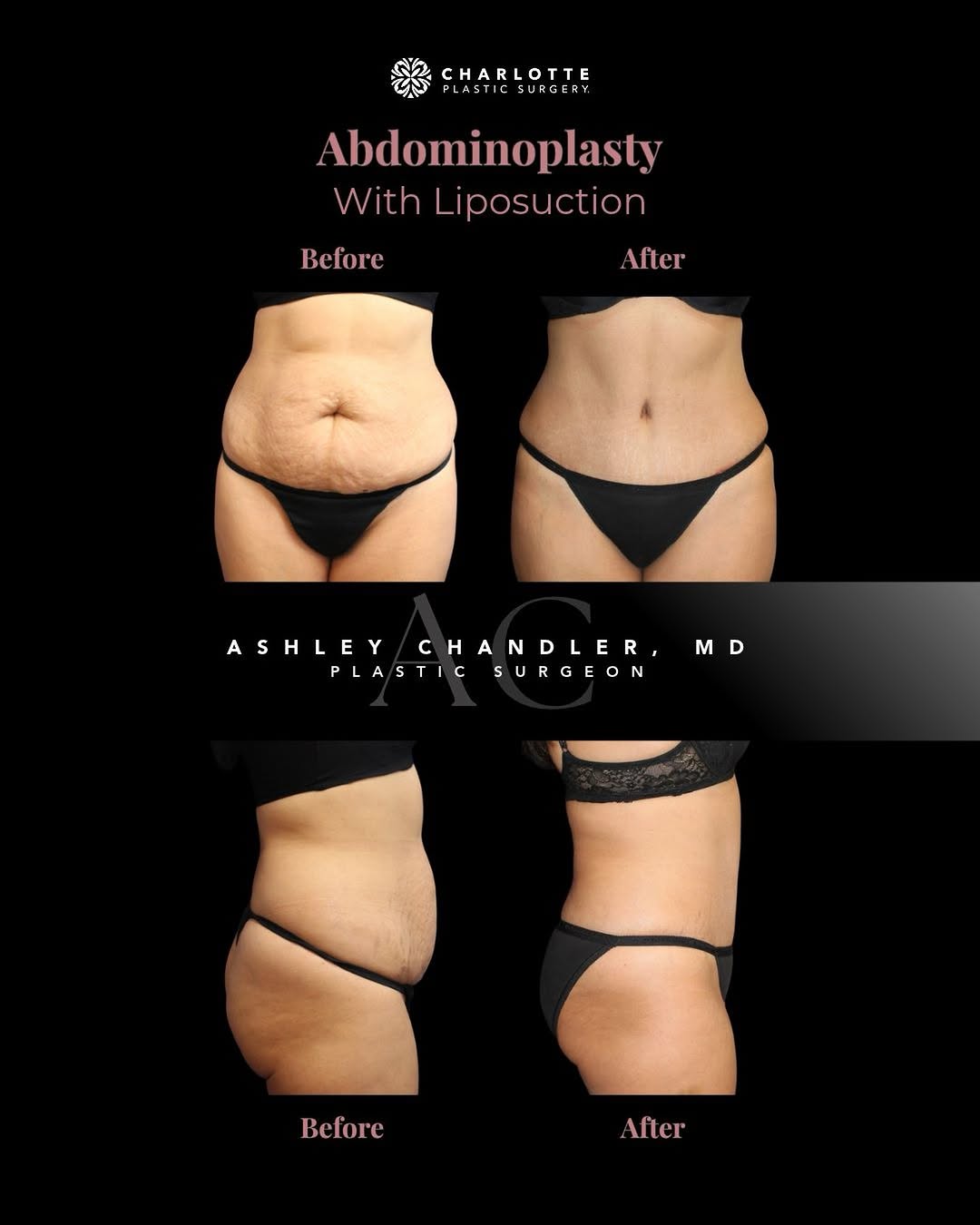 Instagram post by Dr. Ashley Chandler: A flatter, smoother, and more contoured abdomen starts with a personalized surgical plan. ✨ This patient’s transformation included an abdomi…
