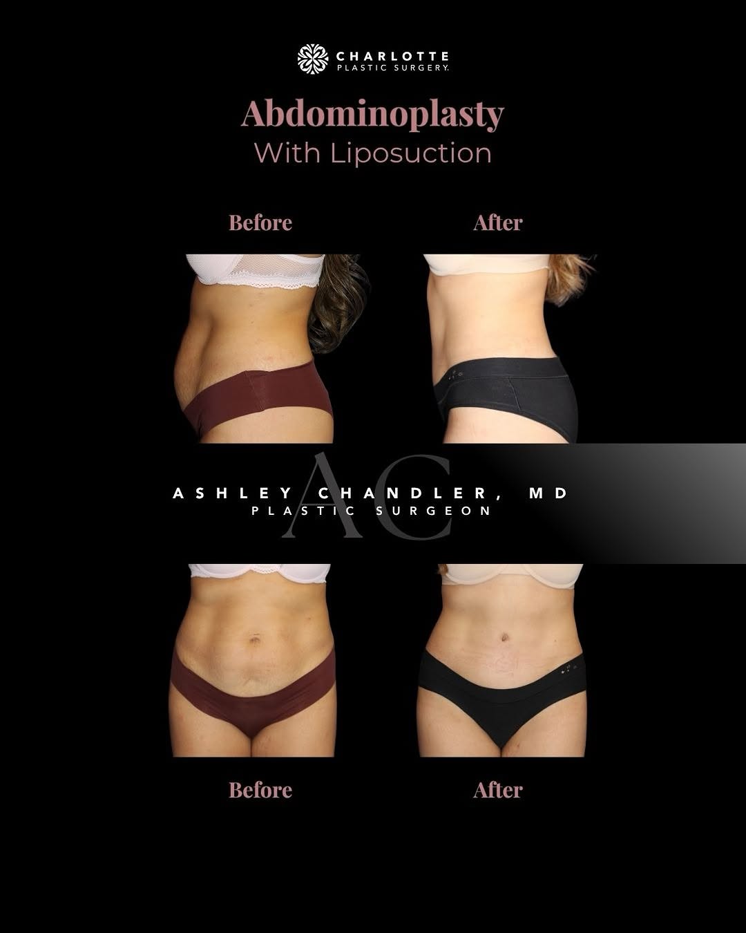 Instagram post by Dr. Ashley Chandler: This before-and-after highlights what can be achieved with a customized approach to body contouring. ✨ I performed an abdominoplasty, common…