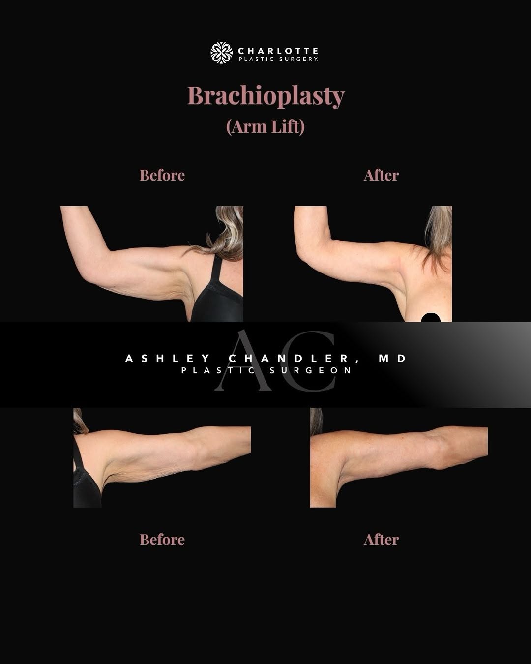 Instagram post by Dr. Ashley Chandler: This arm lift before and after shows the difference that removing excess upper-arm skin can make. ✨ For this patient, I performed a brachiop…