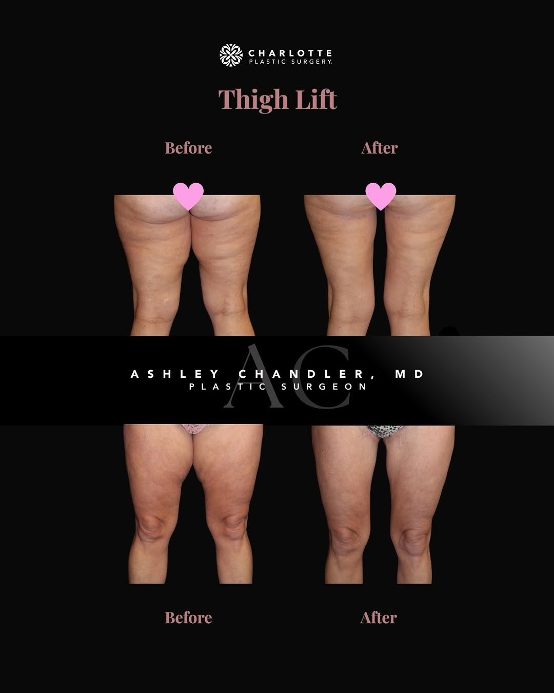 Instagram post by Dr. Ashley Chandler: A closer look at this crescent thigh lift with liposuction before and after. 💖 For this patient, I combined a crescent thigh lift with lipo…
