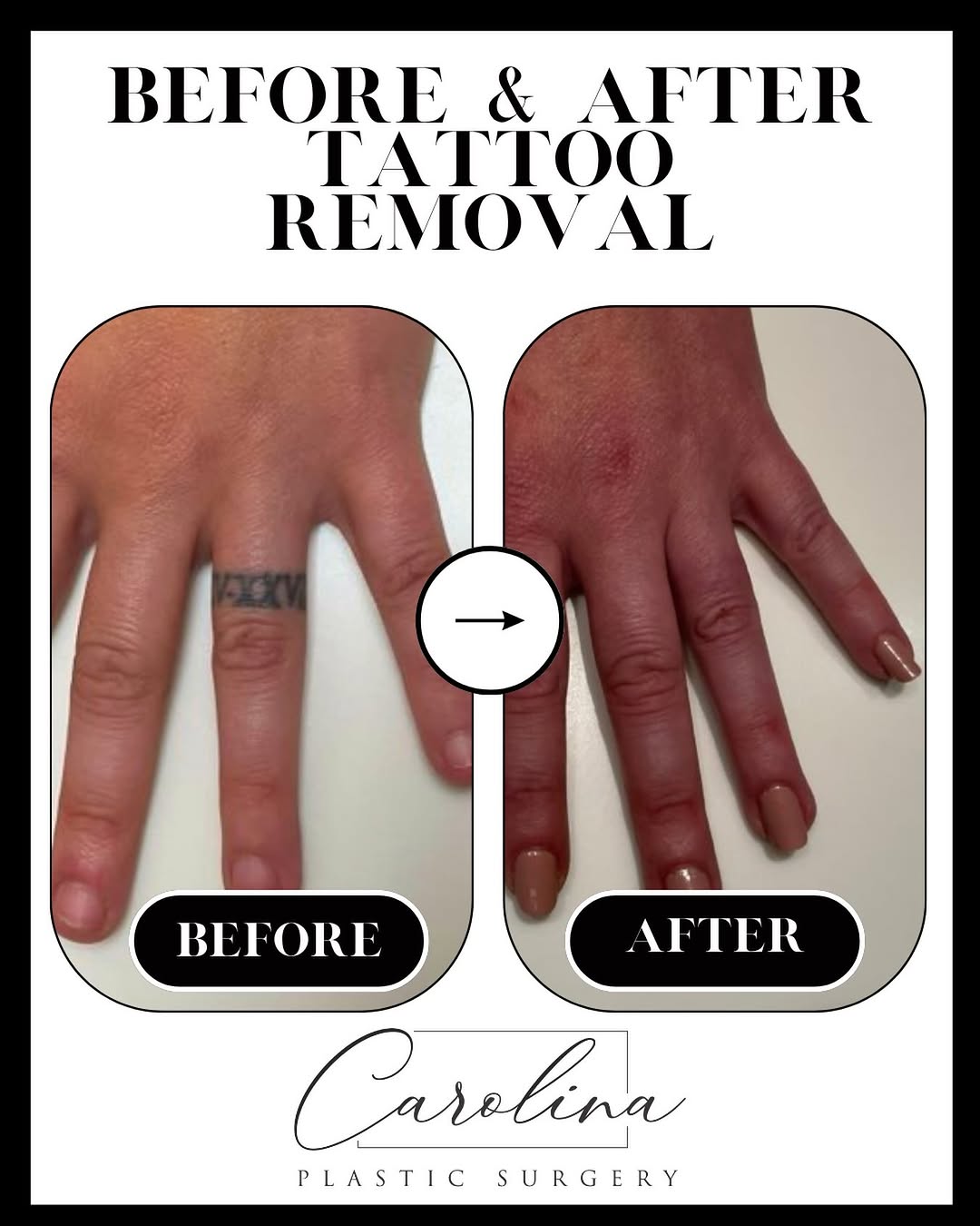 Instagram post by Dr. Ashley Kerekes: Tattoos aren’t always permanent. ✨ Before ➡️ After — completely gone! Call today to start your tattoo removal journey!