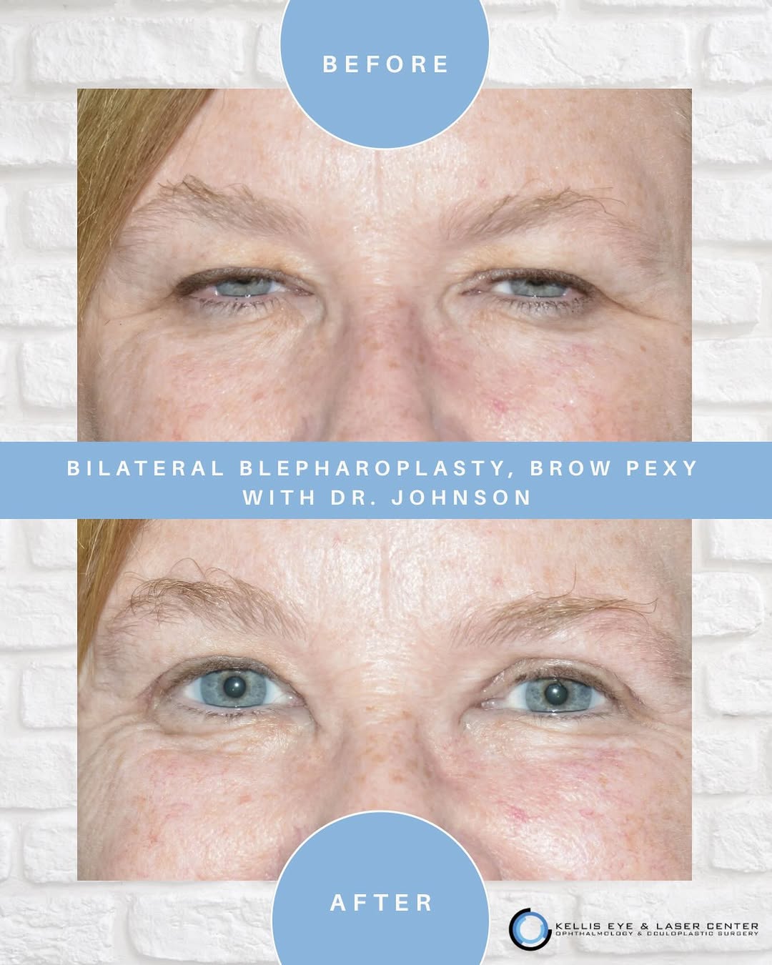 Instagram post by Dr. Augustine J. Kellis: A beautiful result after bilateral blepharoplasty and brow pexy with Dr. Johnson. #oculplastics #oculoplasticsurgery #eyelidsurgery #blephar…