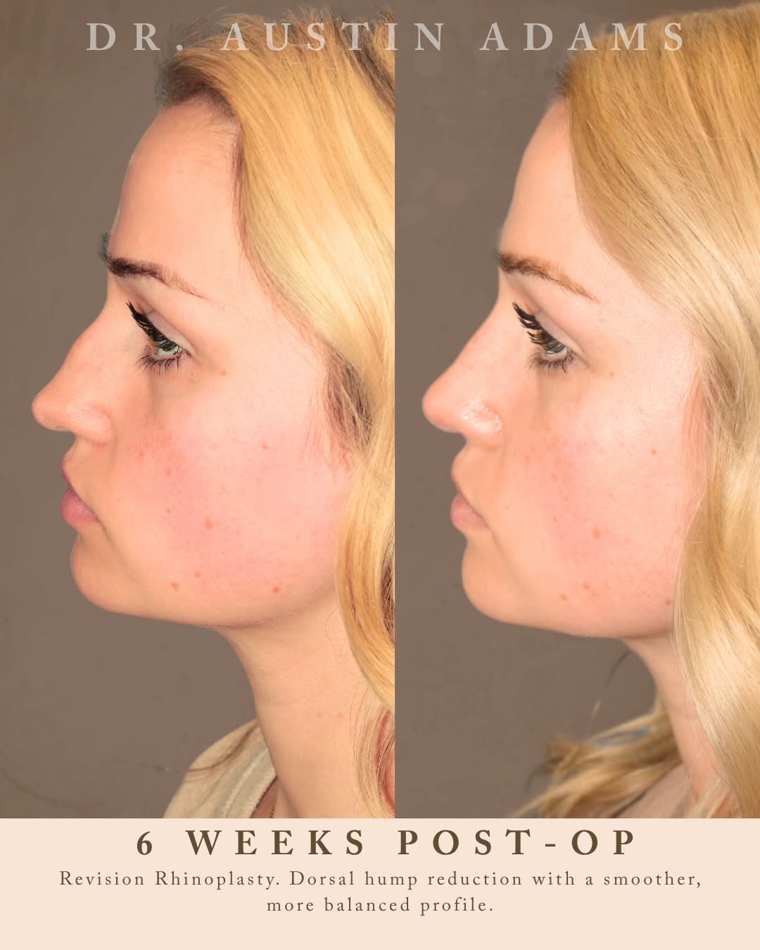 Instagram post by Dr. Austin Adams: 6 weeks after Revision Rhinoplasty ✨ Even in the early stages of healing, her results are already taking shape beautifully. This procedure a…