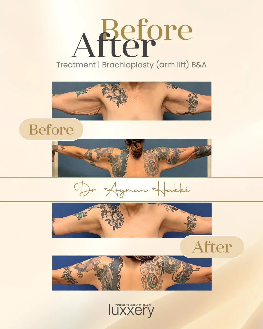 Instagram post by Dr. Ayman Hakki: There is nothing like an arm lift to transform the appearance of your arms. Here's a before and after for those interested in seeing how Dr.…