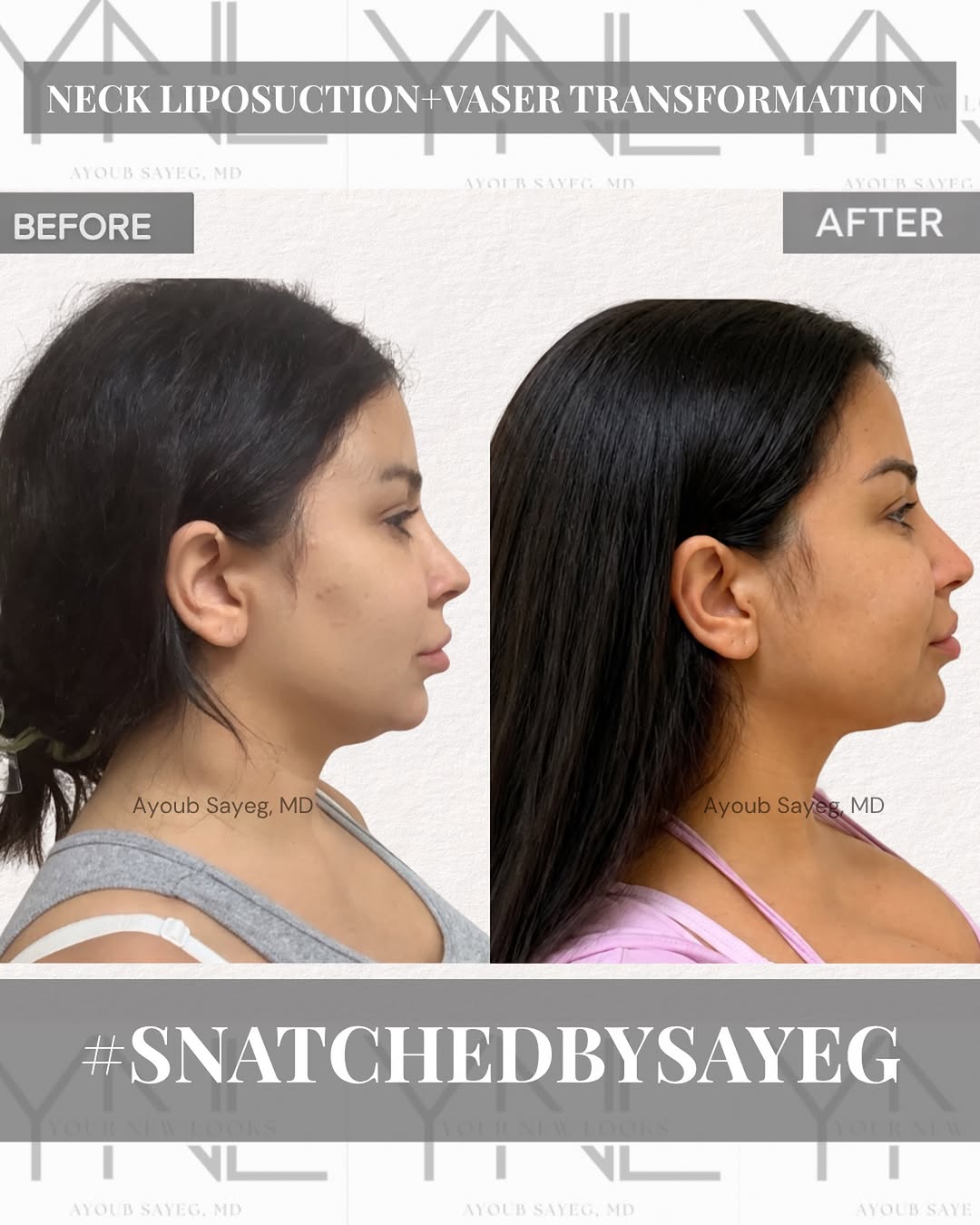 Instagram post by Dr. Ayoub Sayeg: 1 month post-op and the definition is already speaking for itself 😍✨ This gorgeous patient is still early in her healing journey after Neck…
