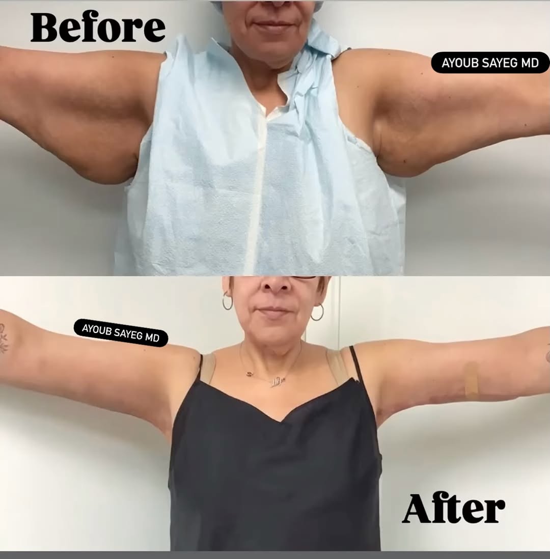 Instagram post by Dr. Ayoub Sayeg: Brachioplasty, a.k.a. Arm Lift- Ayoub Sayeg MD - 🩺 Surgery time ⏰ 2 - 2 1/2 hours Recovery time❤️🩹 -3 weeks Drains - 1 week Results are l…
