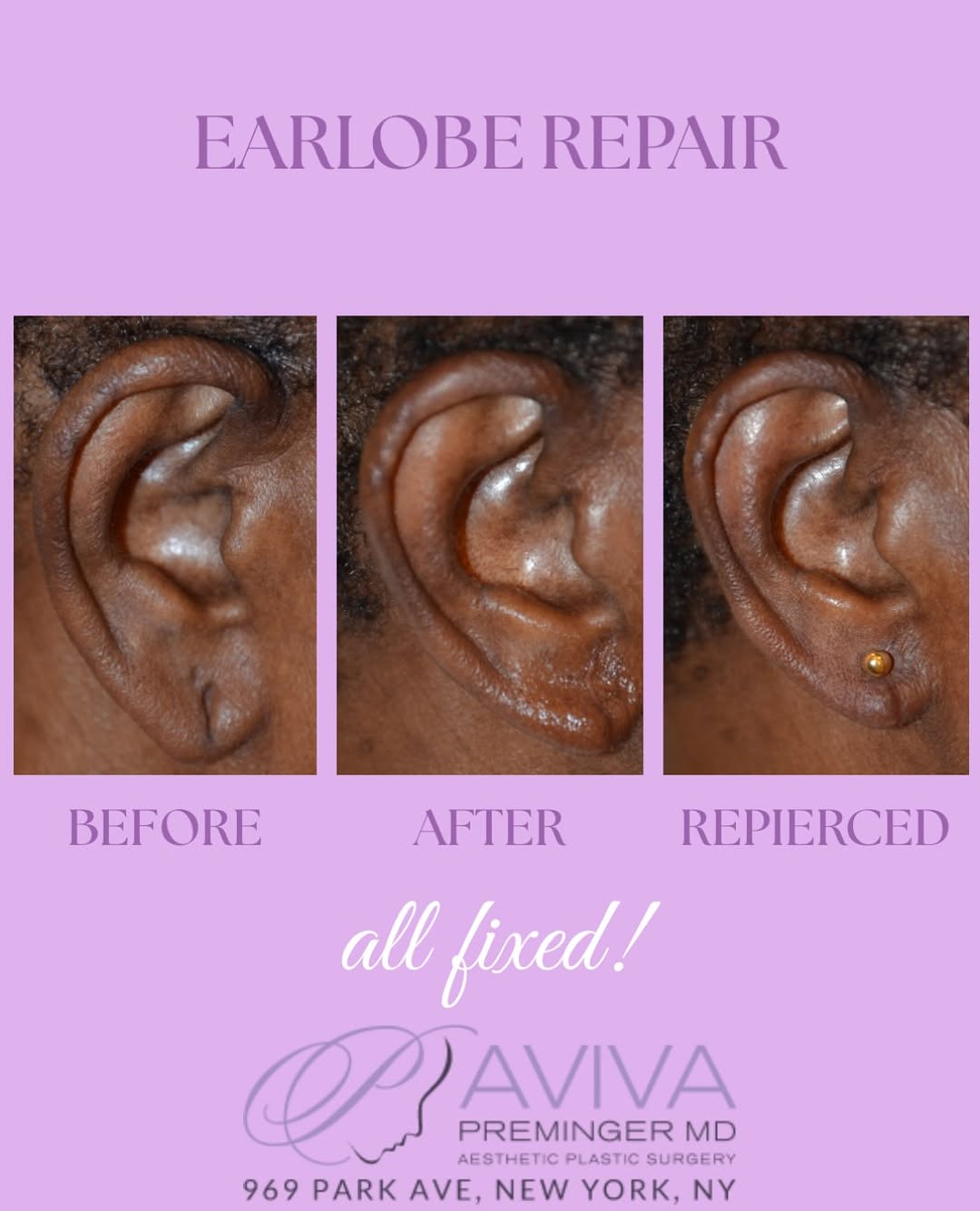 Instagram post by Dr. B. Aviva Preminger: A little repair, a little refresh, and ready for earrings again ✨ This earlobe repair and repiercing restores the shape of the earlobe while…