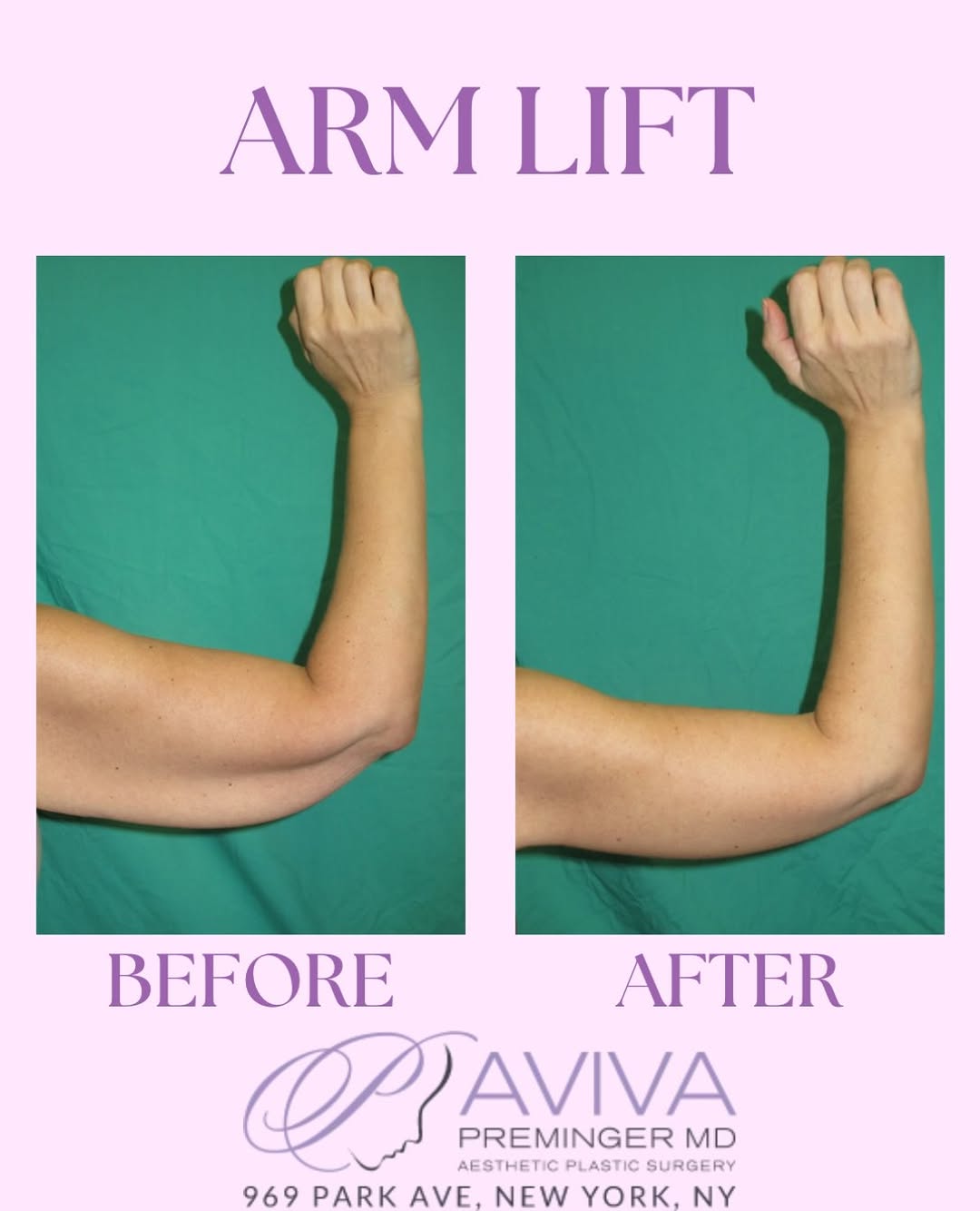 Instagram post by Dr. B. Aviva Preminger: An arm lift (brachioplasty) removes excess skin and reshapes the upper arm for a more contoured, streamlined appearance. A beautiful transfo…