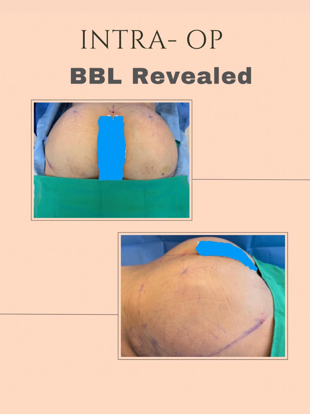 Instagram post by Dr. B. Kalantarian: Direct from the OR. 🩺 Seamless contours and a completely personalized silhouette. This intraoperative look highlights the immediate transit…